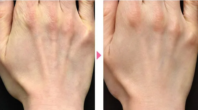 湘南美容クリニックのプロファイロの症例写真