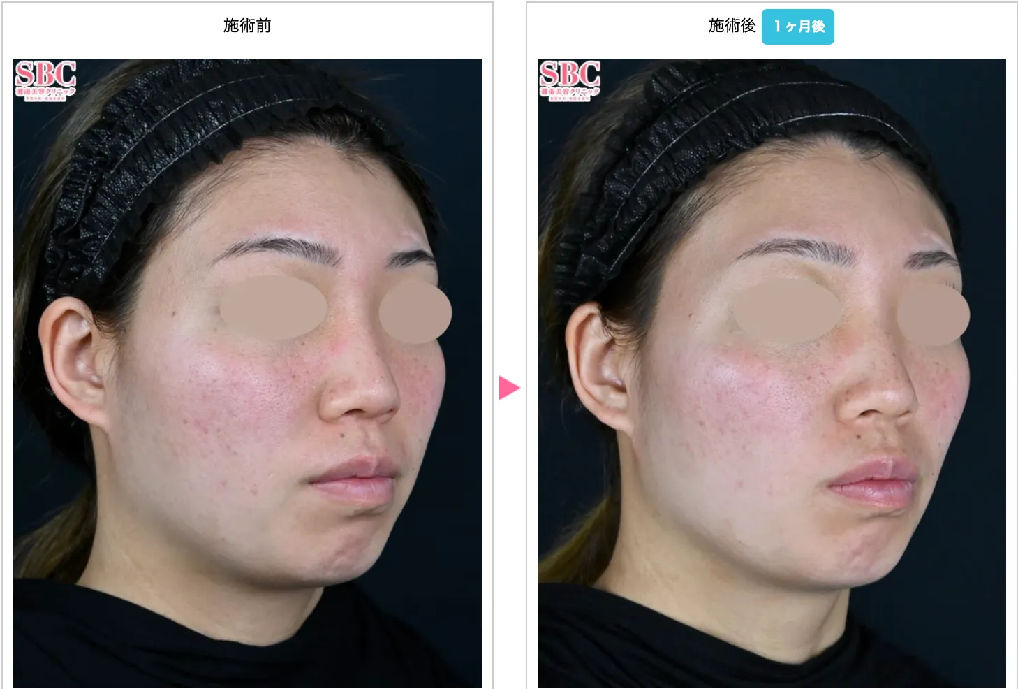 札幌で安いとおすすめの湘南美容クリニックのオンダリフトの症例写真