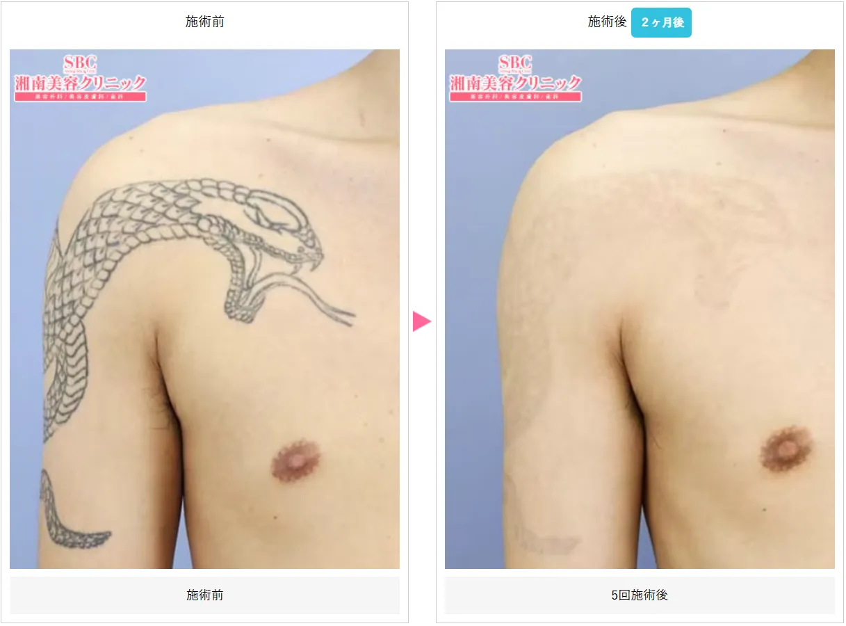 広島でタトゥー除去(刺青除去)が安いおすすめクリニック 湘南美容クリニック 症例写真②