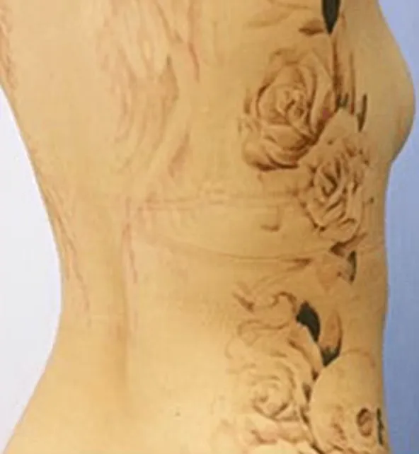 ピコレーザーの照射1回目