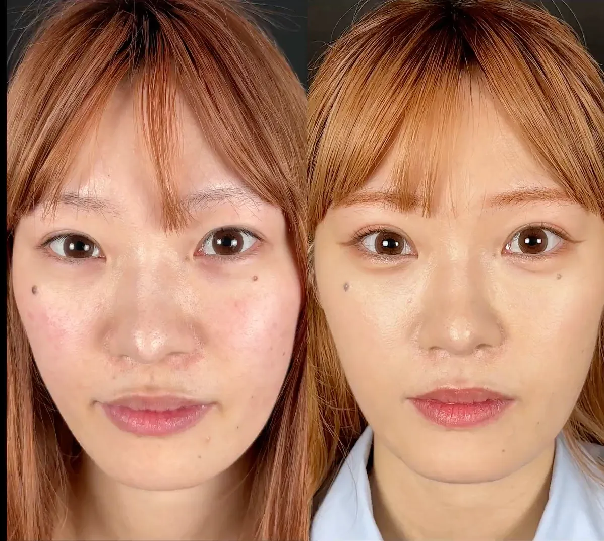 口コミ評判の良いTクリニックの二重整形の症例写真