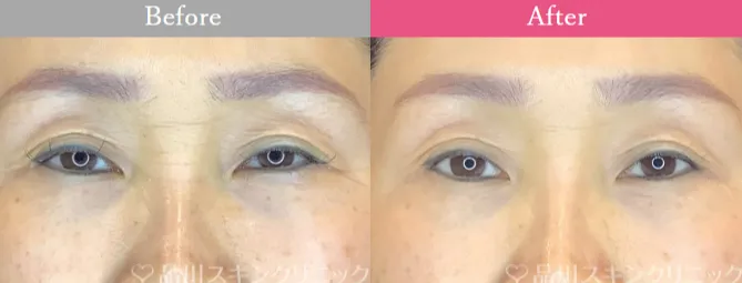 仙台でエリシスセンスが安いおすすめクリニック品川美容外科の症例