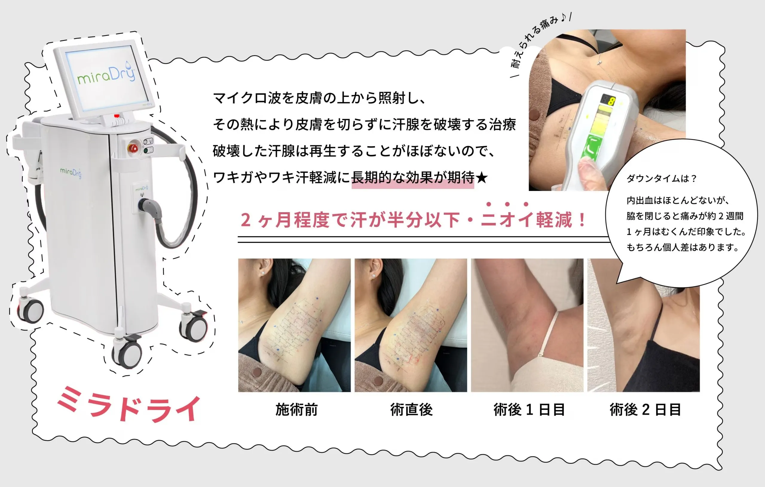 仙台でミラドライが安い湘南美容クリニック