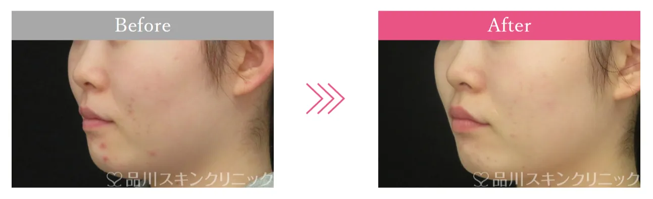 仙台でエリシスセンスが安いおすすめクリニック品川美容外科の症例