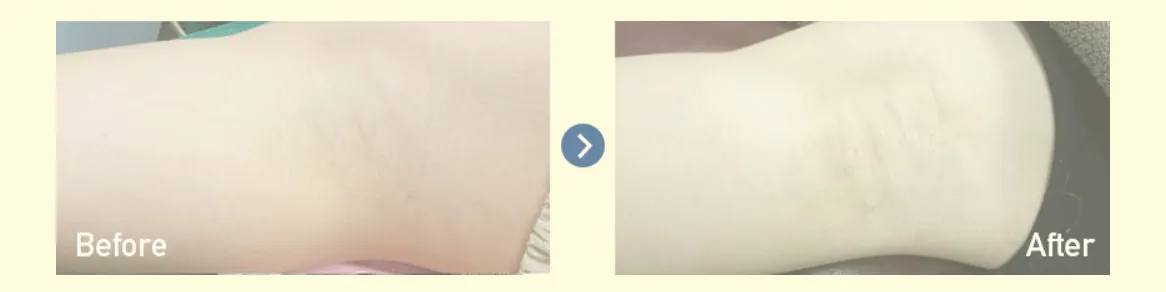 沖縄で安いミラドライがおすすめな湘南美容クリニックの症例写真