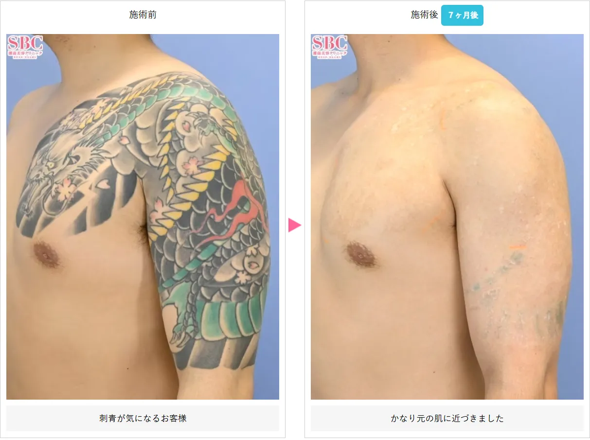 大分でタトゥー除去(刺青除去)が安いおすすめクリニック 湘南美容クリニック 症例写真①