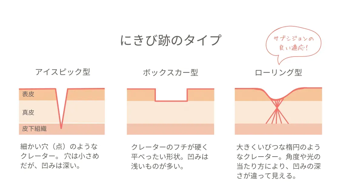 サブシジョン ニキビ跡のタイプ