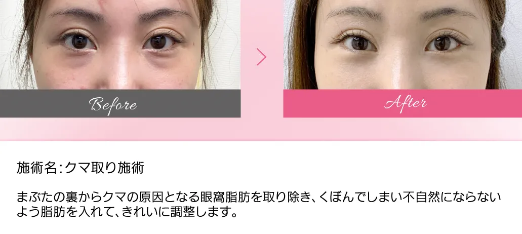 ビューティスクリニックのクマ取りの症例