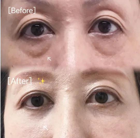 ビューティスクリニックのクマ取りの症例写真