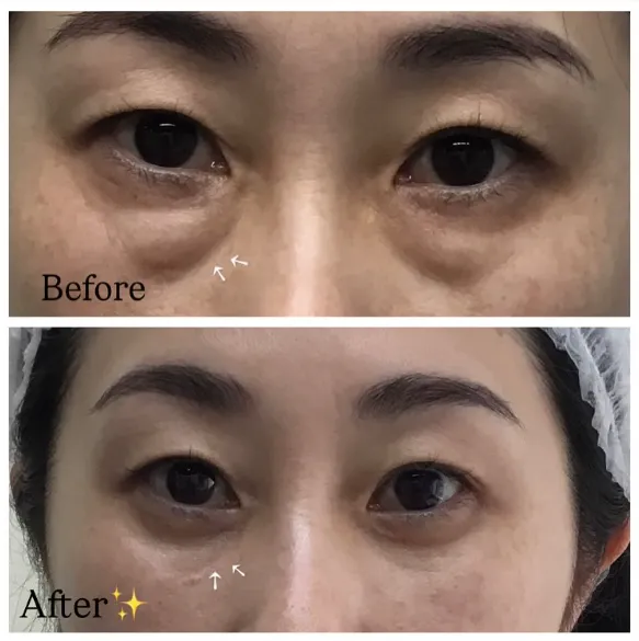 ビューティスクリニックのクマ取りの症例写真