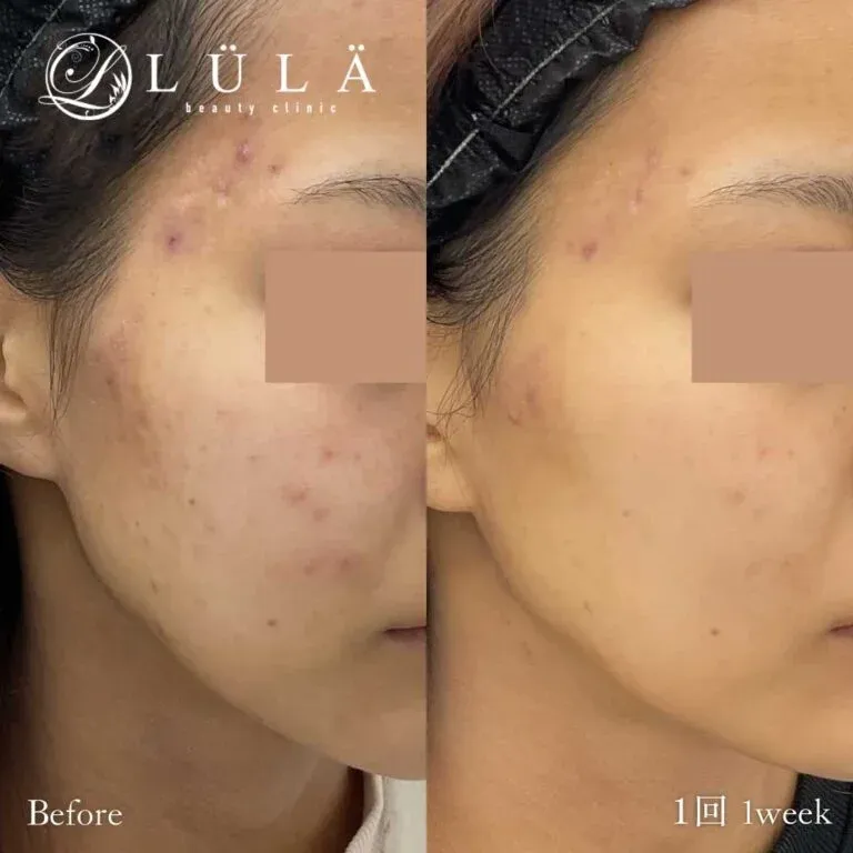 広島でポテンツァが安いおすすめのルラ美容クリニック 症例写真2