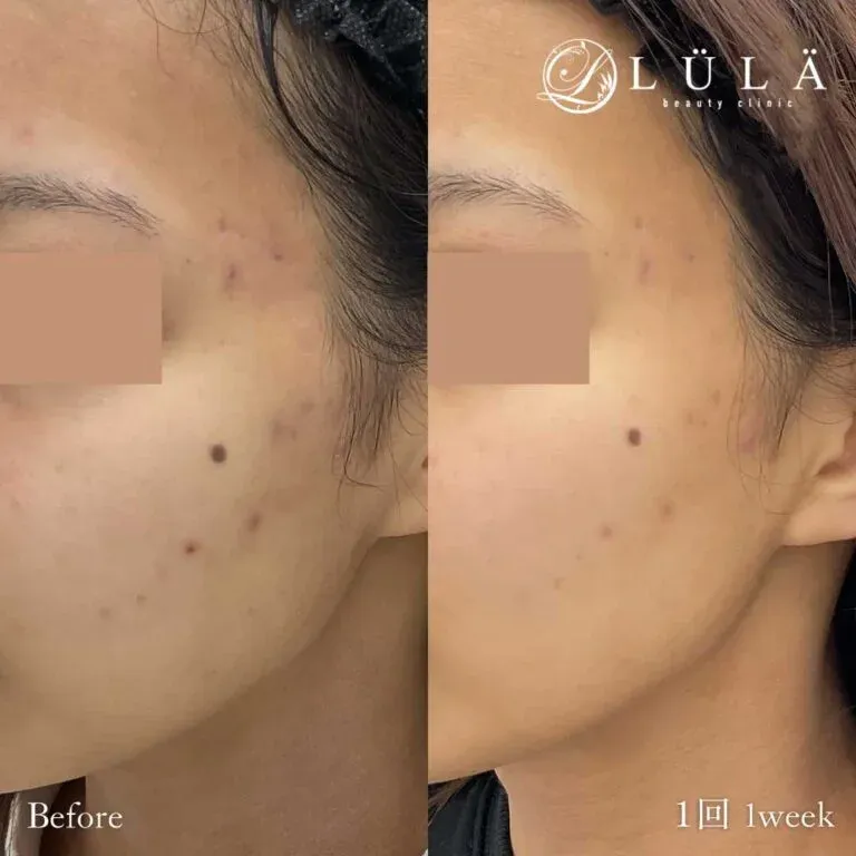栄でポテンツァが安いおすすめのルラ美容クリニック 症例写真2