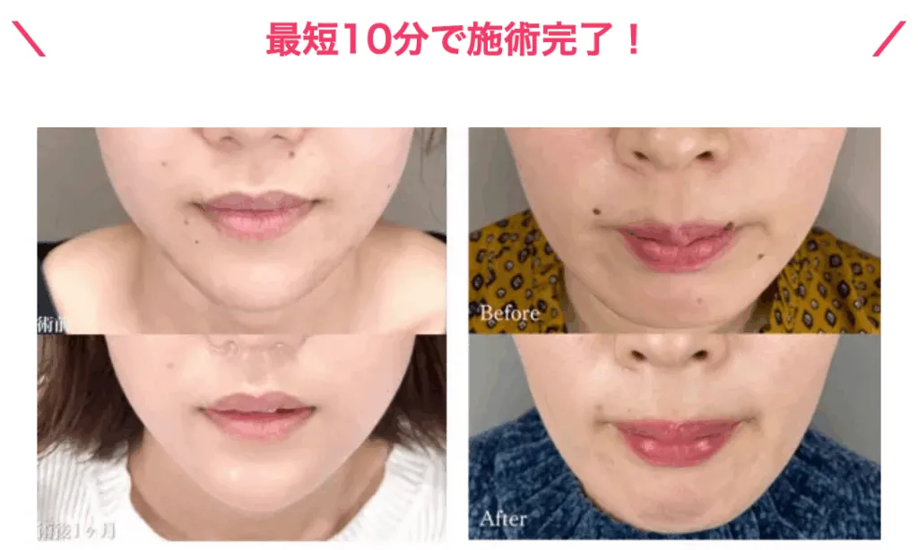 神戸でほくろ除去でおすすめ
