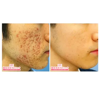 SBCのケミカルピーリングの症例