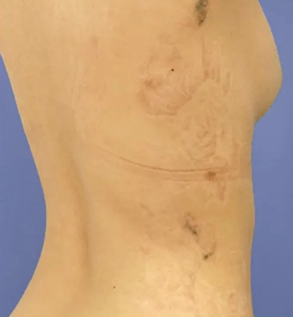 ピコレーザーの施術5回目