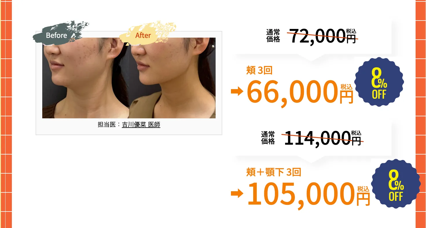 沖縄でオンダリフトが安いおすすめクリニックの湘南美容クリニックのオンダリフトのキャンペーン価格