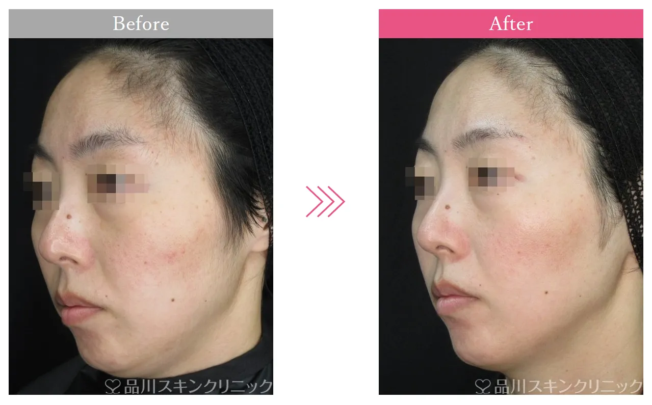 新潟でエリシスセンスが安いおすすめクリニック品川美容外科の症例