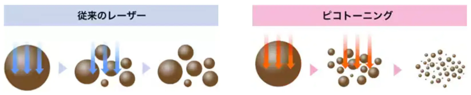 湘南美容クリニック 従来のレーザーとピコトーニングの違い
