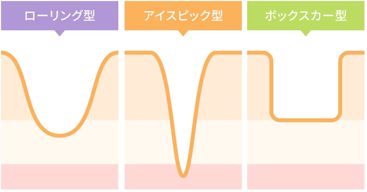 TCBのサブシジョンで効果があるニキビ跡の種類