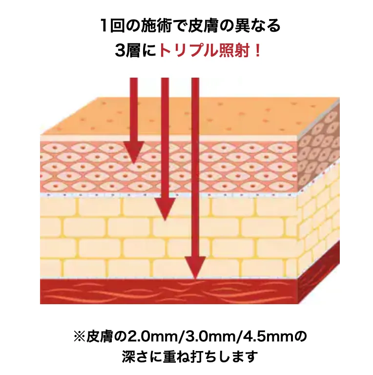大阪で医療ハイフの安いおすすめ人気クリニック 湘南美容クリニックの施術の図解