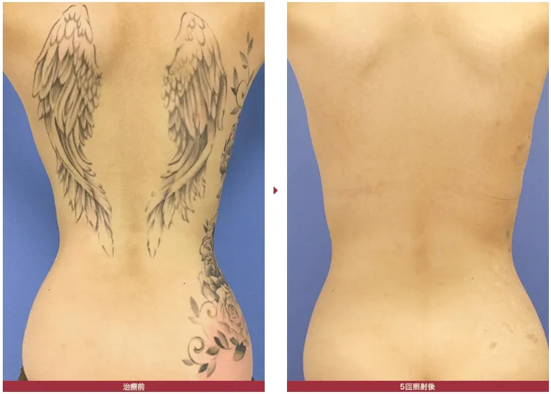 湘南美容クリニックのタトゥー除去(刺青除去)の症例写真