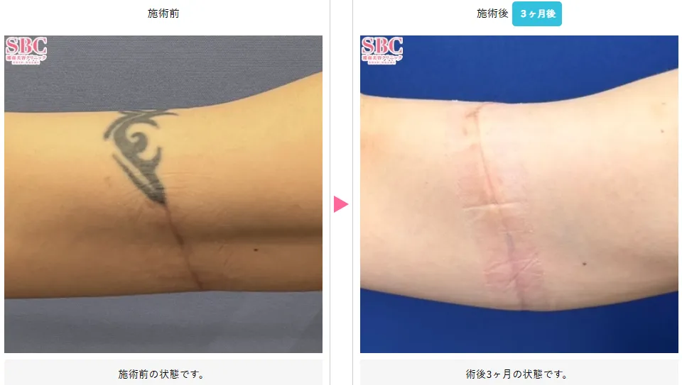 湘南美容クリニックのタトゥー除去(刺青除去)の症例写真
