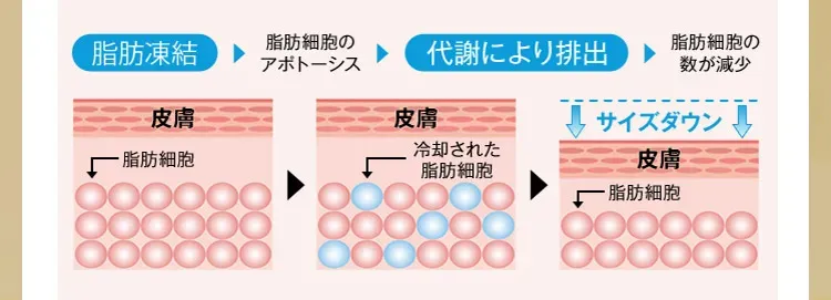 ディオクリニックの脂肪冷却の解説