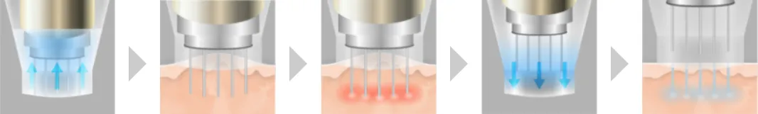 栄でポテンツァが安いおすすめのルラ美容クリニック ポテンツァの施術内容
