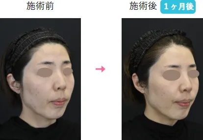 札幌でジャルプロスーパーハイドが安い湘南美容 症例写真2