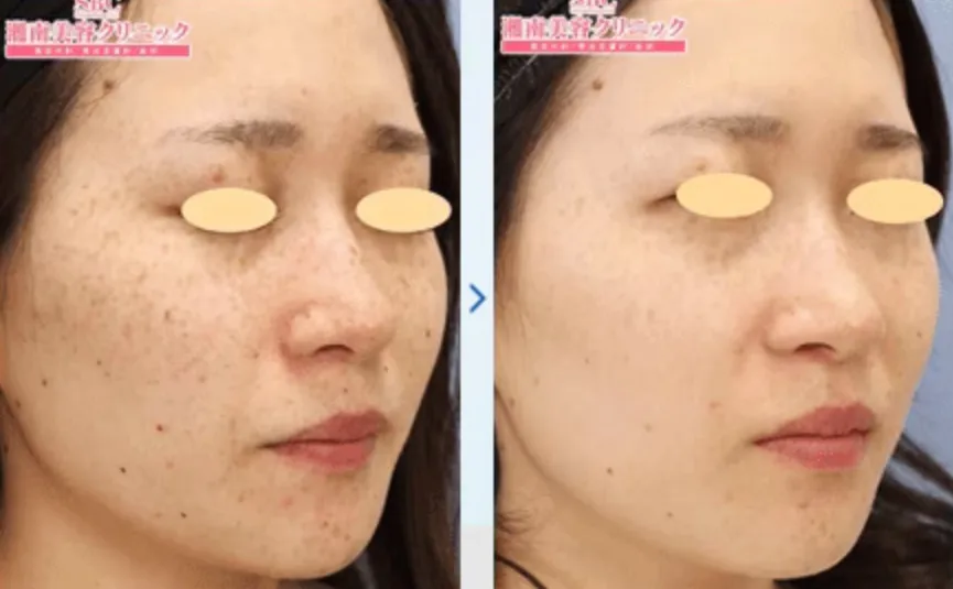 名古屋でピコトーニングが安いおすすめのクリニック湘南美容クリニック 症例写真