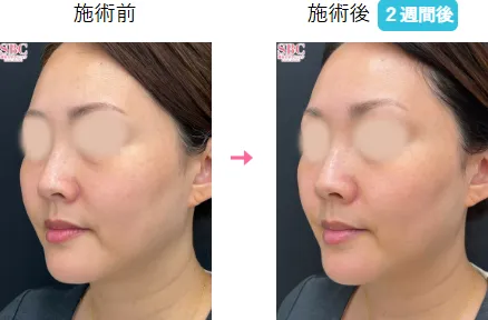 札幌でジャルプロスーパーハイドロが安いおすすめの湘南美容クリニック 症例写真3