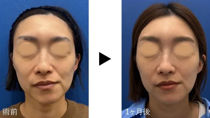 札幌でジャルプロスーパーハイドが安い湘南美容 症例写真