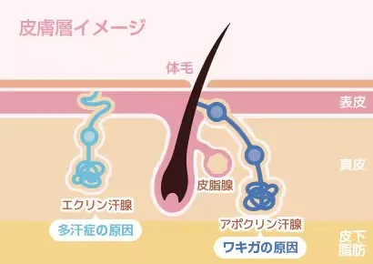 沖縄で安い料金でワキガ・多汗症治療ができるミラドライの仕組み