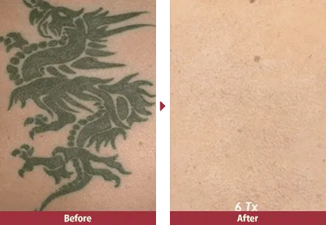 湘南美容クリニックのタトゥー除去(刺青除去)の症例写真