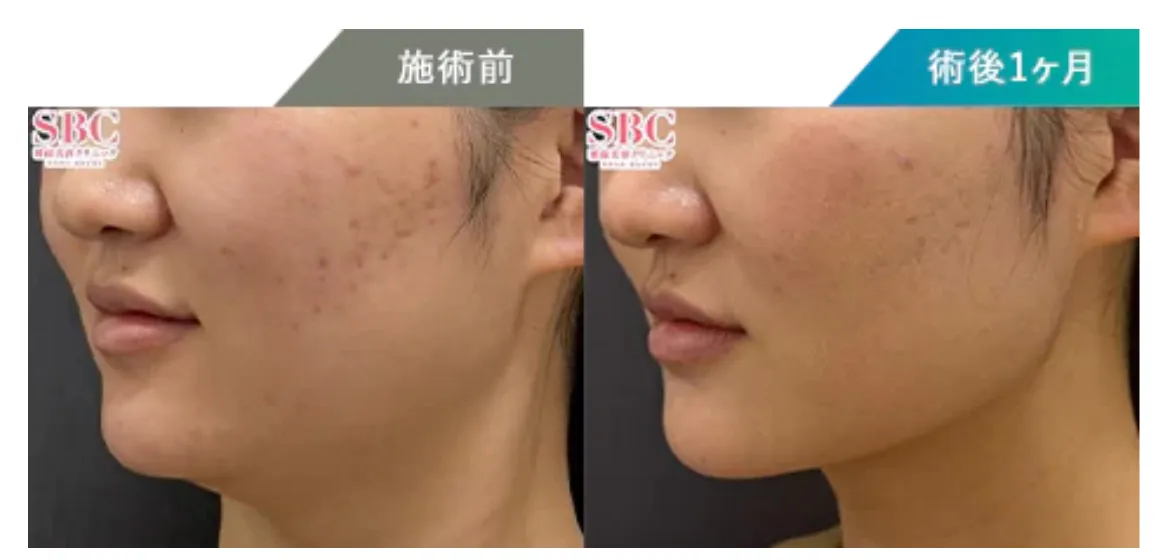 湘南美容クリニックで実際にオンダリフトの施術を受けた方の症例写真