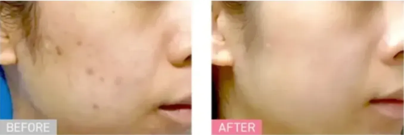 石川/金沢 安い おすすめ TCBのサブシジョンの施術を受けた方の症例写真