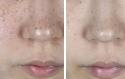 湘南美容クリニックのフォトフェイシャルの症例