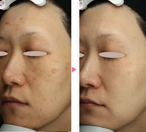 湘南美容クリニックのフォトフェイシャルの症例