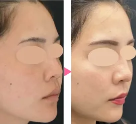 湘南美容クリニックのフォトフェイシャルの症例