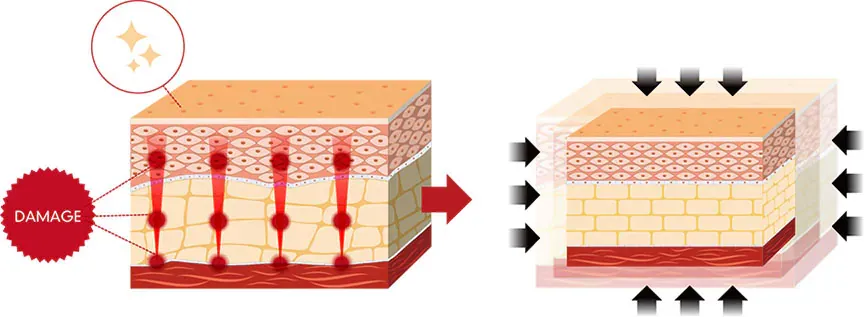 神戸で医療ハイフが安いおすすめ人気クリニック 湘南美容クリニックのLP画像 医療ハイフの効果