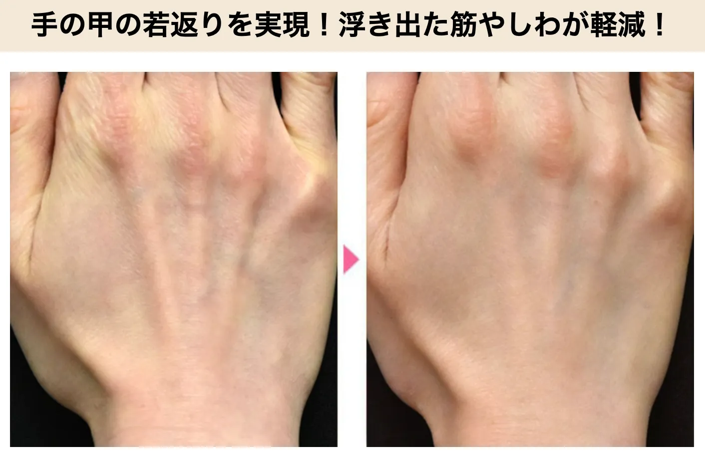 神戸で安いプロファイロがおすすめの湘南美容クリニック 症例写真