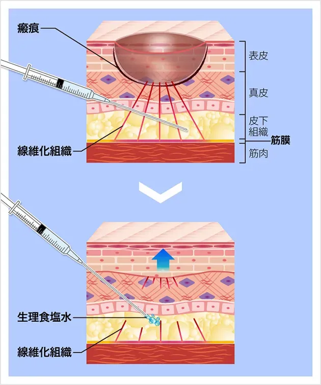 TCBのサブシジョンの施術説明