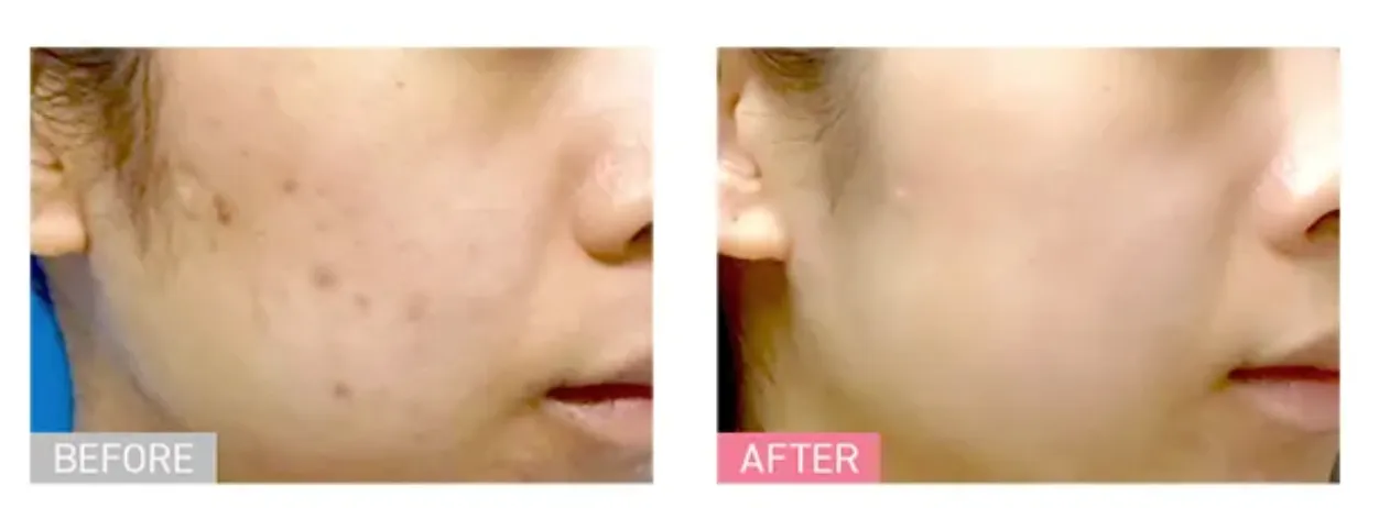 TCBのサブシジョンの施術を受けた方の症例写真