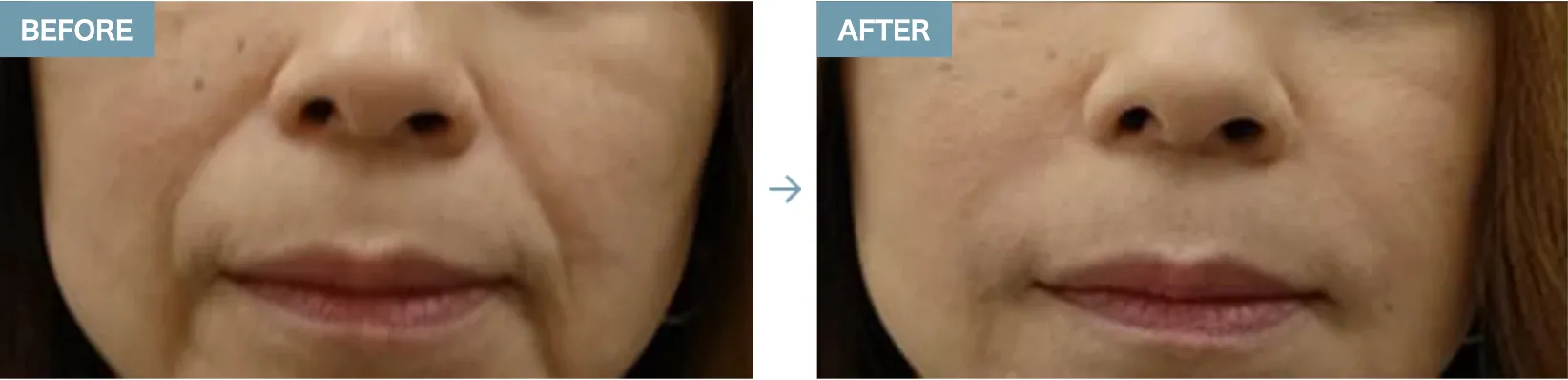 京都でヒアルロン酸注射ができるおすすめのクリニックTCBの症例写真