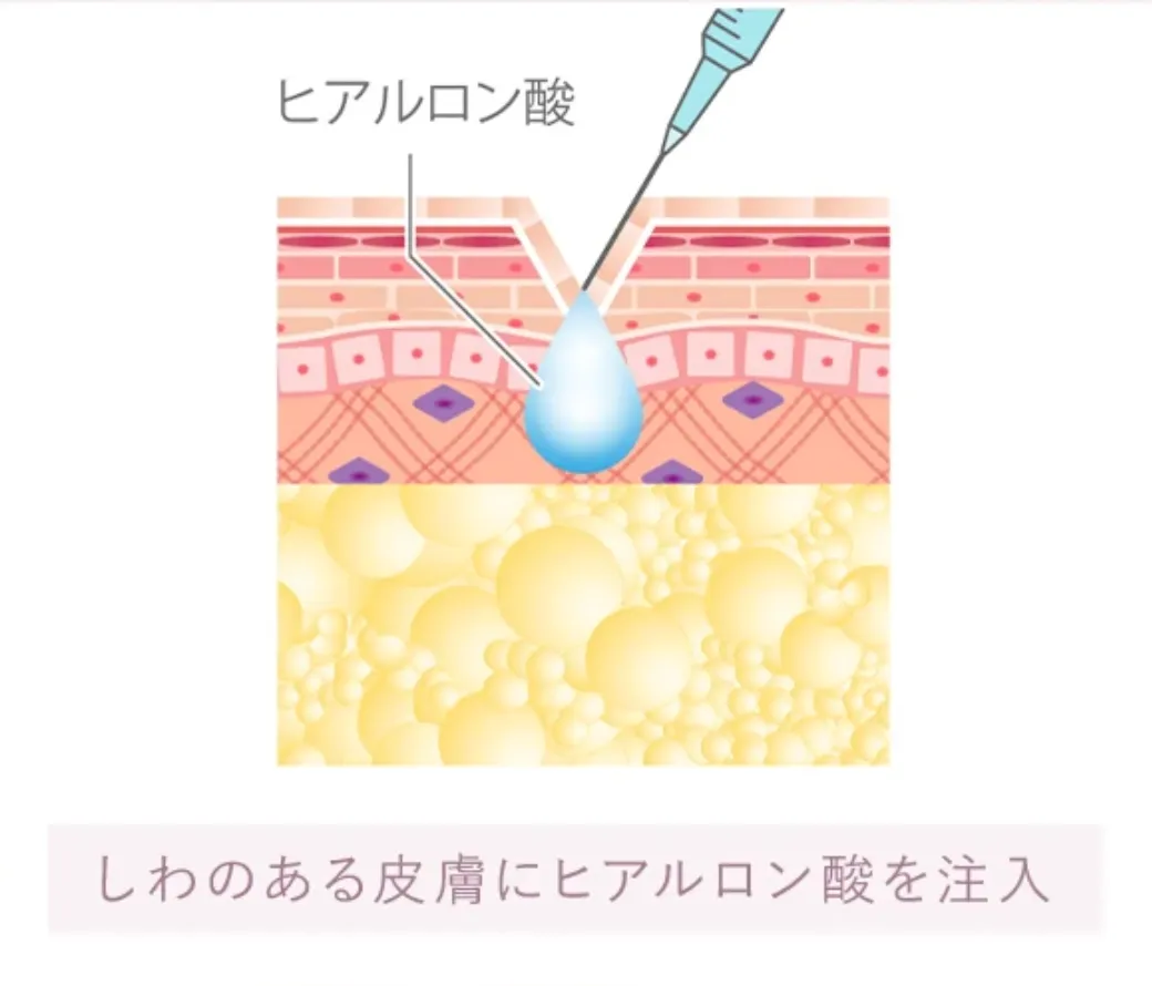 京都でヒアルロン酸注射ができるおすすめのクリニックTCBの施術の流れ②