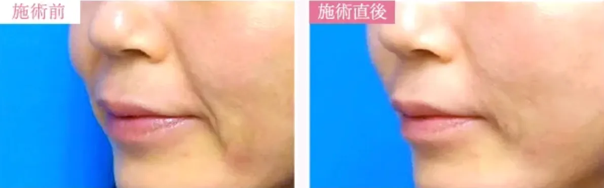 京都でヒアルロン酸注射ができるおすすめのクリニックTCBの症例写真