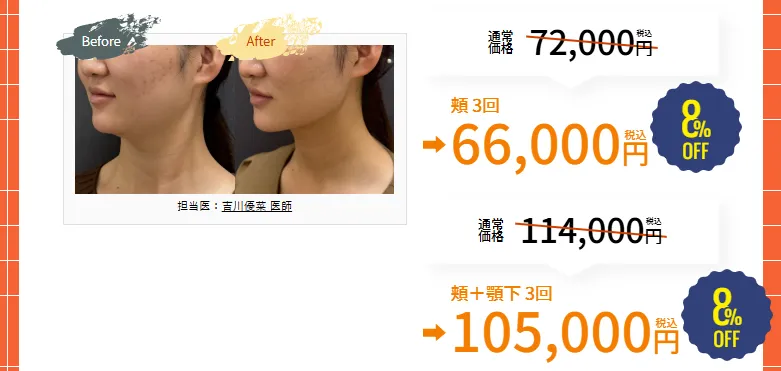 京都でオンダリフトが安いおすすめのクリニック 湘南美容クリニックのLP画像 期間限定キャンペーン