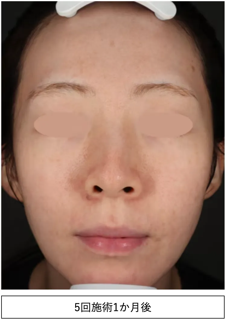 湘南美容クリニックのフォトフェイシャル症例写真の施術5回目