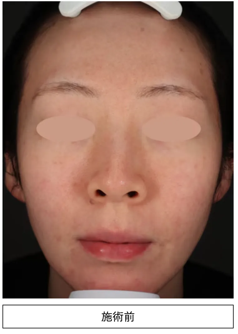 湘南美容クリニックのフォトフェイシャル症例写真の施術前