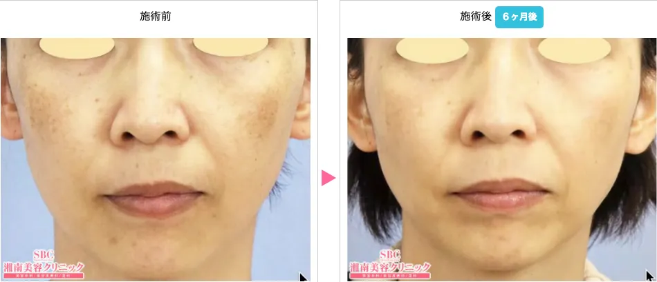 京都でピコトーニングが安いおすすめの湘南美容クリニック 症例画像